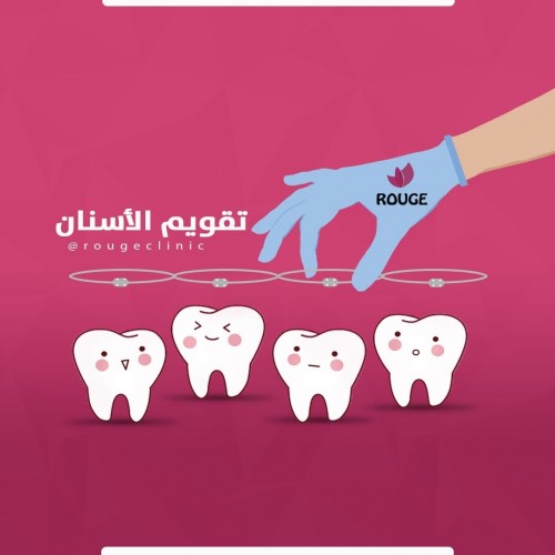 تقويم الأسنان بدفعة أولى 1500 ريال