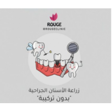 زراعة الأسنان الجراحية بدون تركيبة