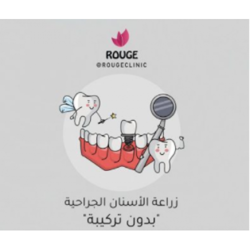 زراعة الأسنان الجراحية بدون تركيبة